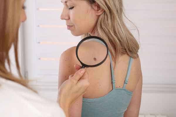 What Are Traditional Skin Lesion Removal Methods Romford?