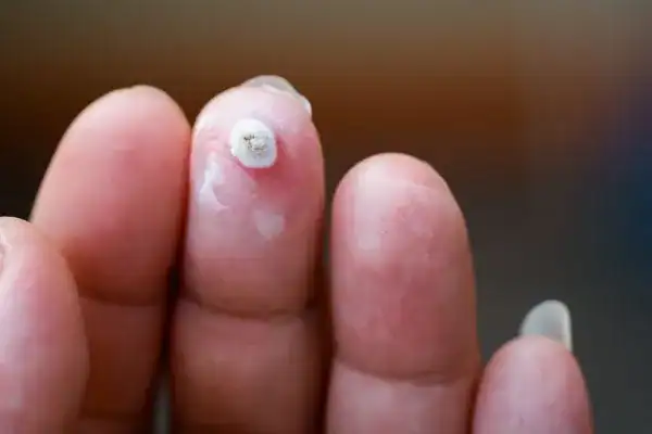 Image of white wart before cryopen treatment Romford