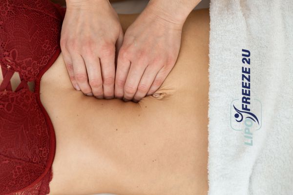 diastasis recti treatment Romford