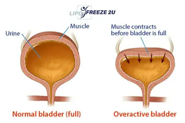 diagram of overactive bladder treatment Romford