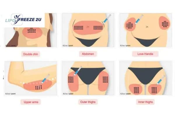 Benefits of Choosing Aqualyx for Fat Reduction Romford