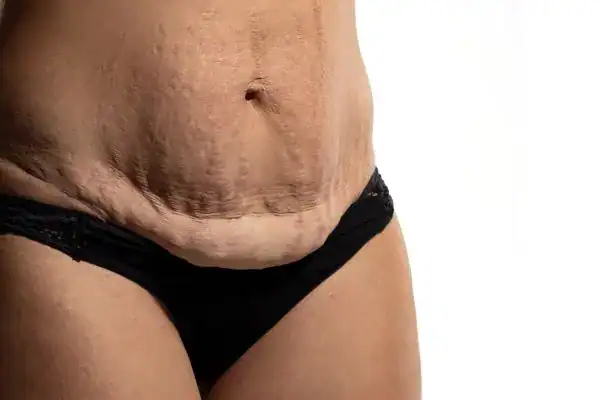 loose skin after weight loss injections Romford
