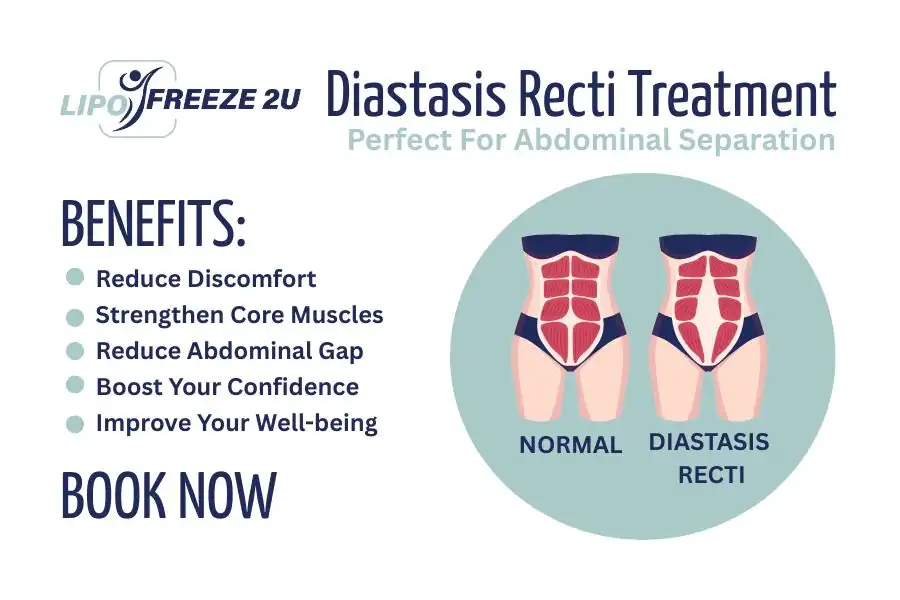 Benefits of body toning treatment Romford for Diastasis recti