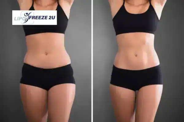 How Can LIPO FREEZE 2U Support Your Post-Pregnancy Body Recovery Romford?