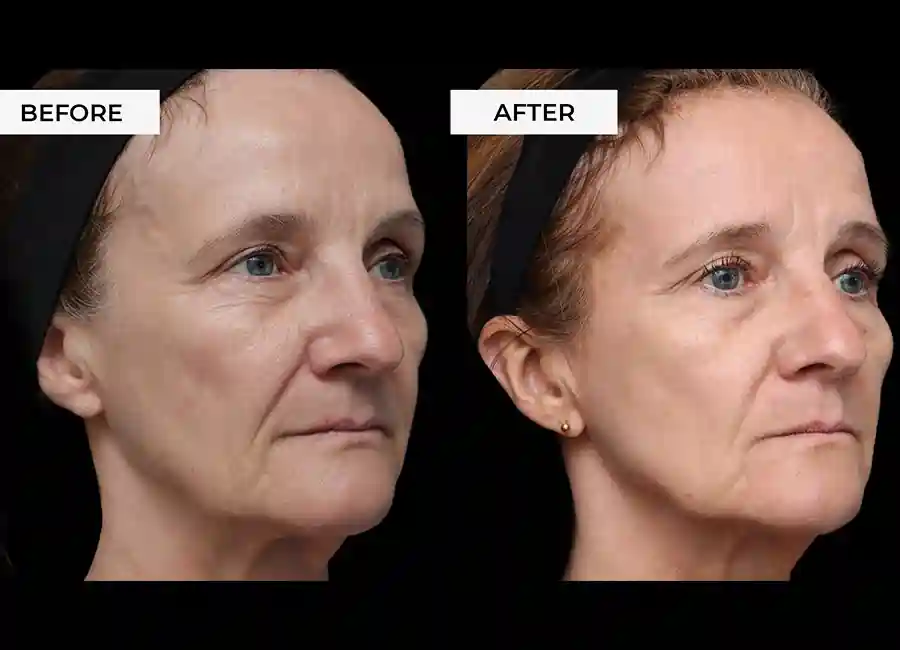 How Many RF Microneedling Sessions Will You Need to See a Difference Romford?