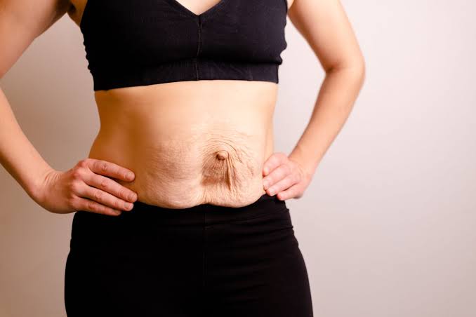 Is Surgery Really the Only Way to Repair Diastasis Recti Romford?
