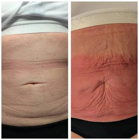 How Does RF Microneedling Improve Crepey, Thin and Uneven Skin Texture Romford?