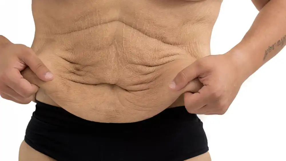 RF Microneedling for Loose Skin: How Can It Help Tighten and Reshape the Skin Romford?